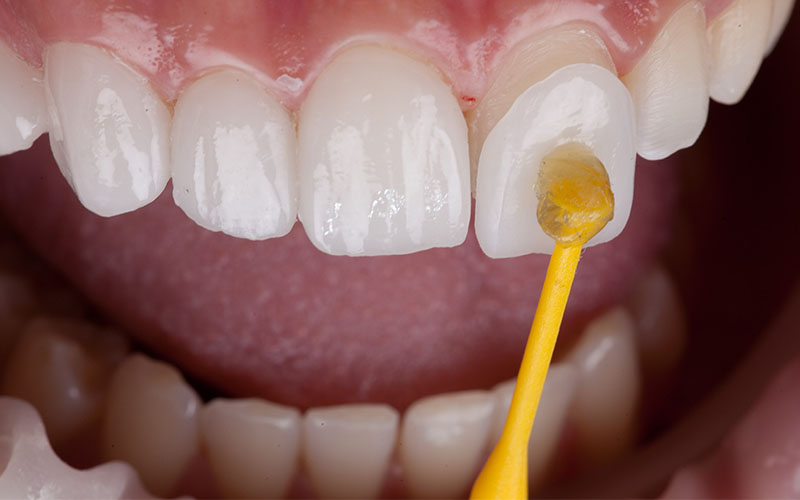 Central Dental Family - Patient getting veneers